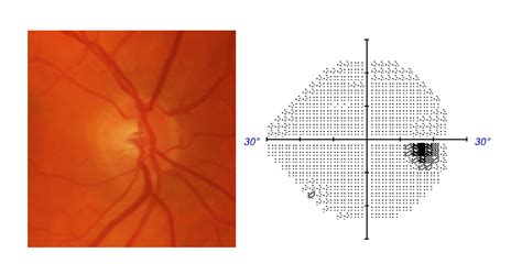 they prform glaucoma test without putting numbing drops|Breaking Down Visual Fields in Glaucoma .